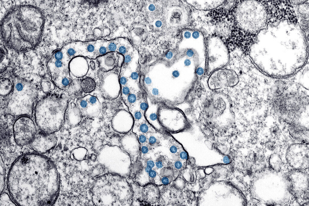 This 2020 electron microscope image made available by the U.S. Centers for Disease Control and Prevention shows the spherical particles of the new coronavirus, colorized blue, from the first U.S. case of COVID-19. (The Associated Press File)