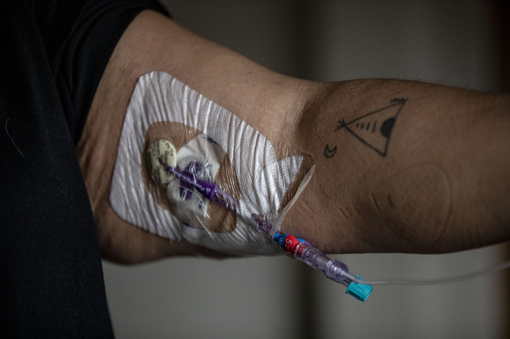 Kendra Lippyshows the port for her TPN bag, where she receives IV nutrients, at her home in Colorado Springs. (Chancey Bush, The Gazette)