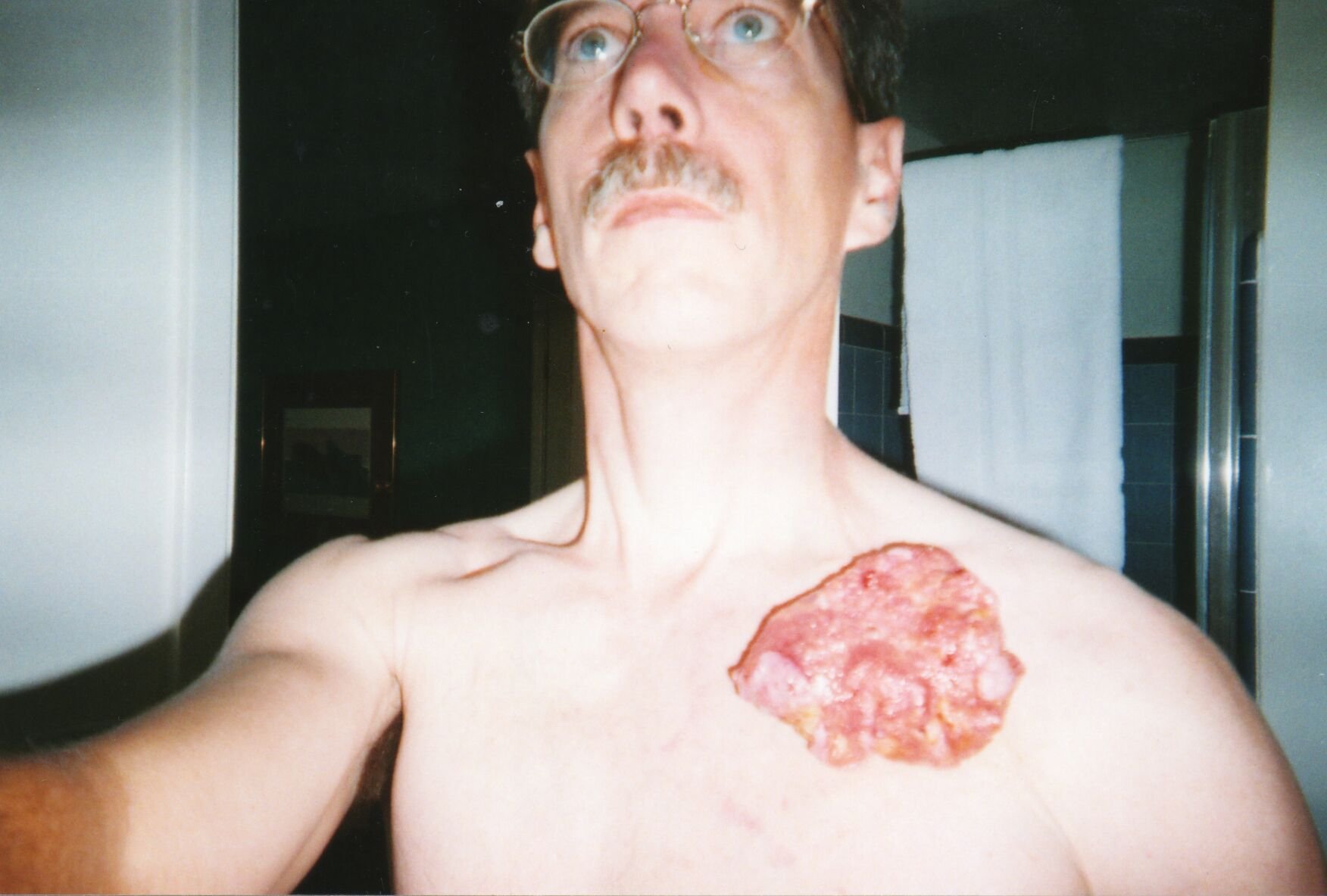 The cancer that first appeared on Mike Hoesch’s shoulder grew to be this size in 2003. (Courtesy photo)