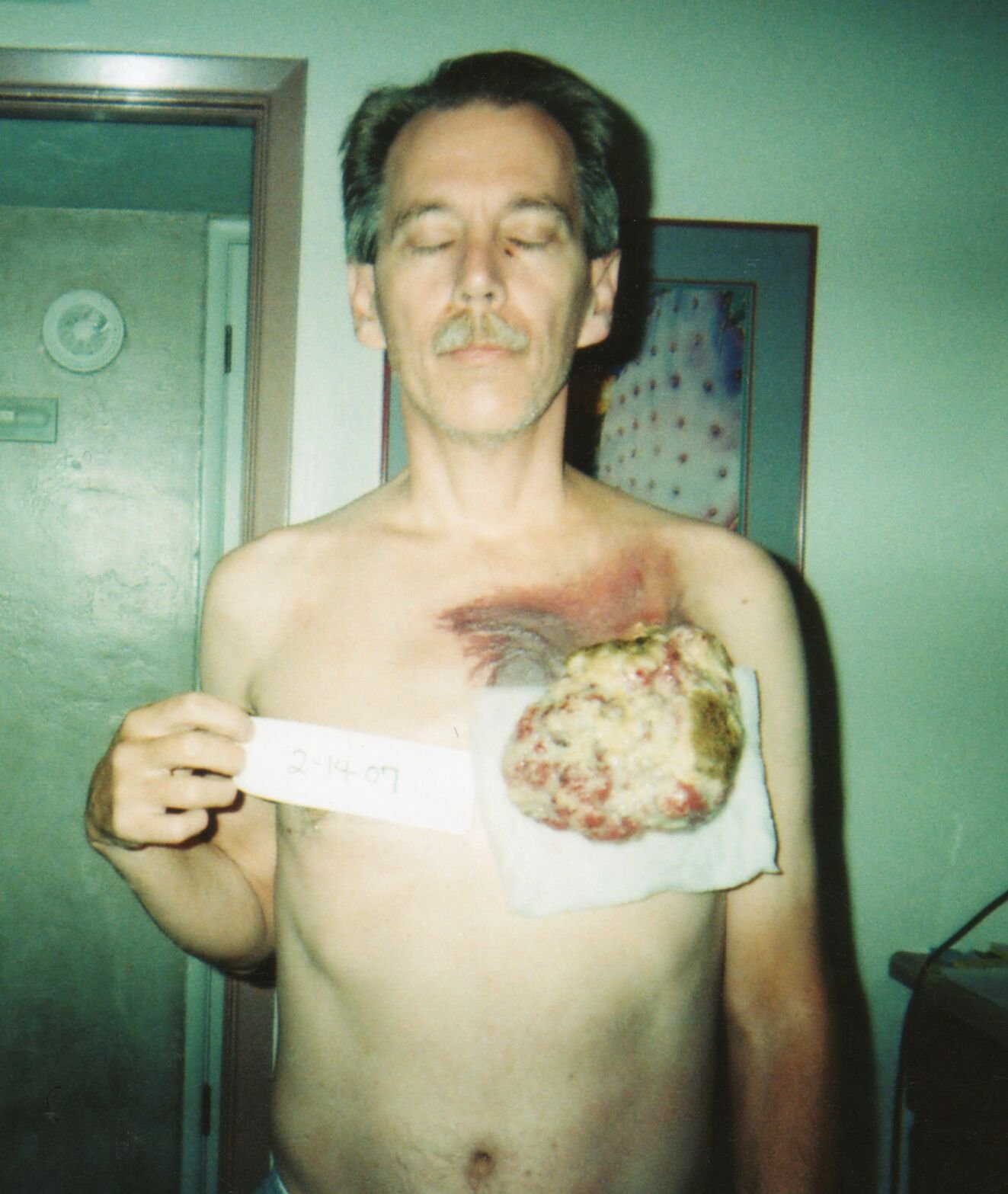 By 2007, the malignant tumor on Mike Hoesch's chest had grown significantly and started spreading. (Courtesy photo)
