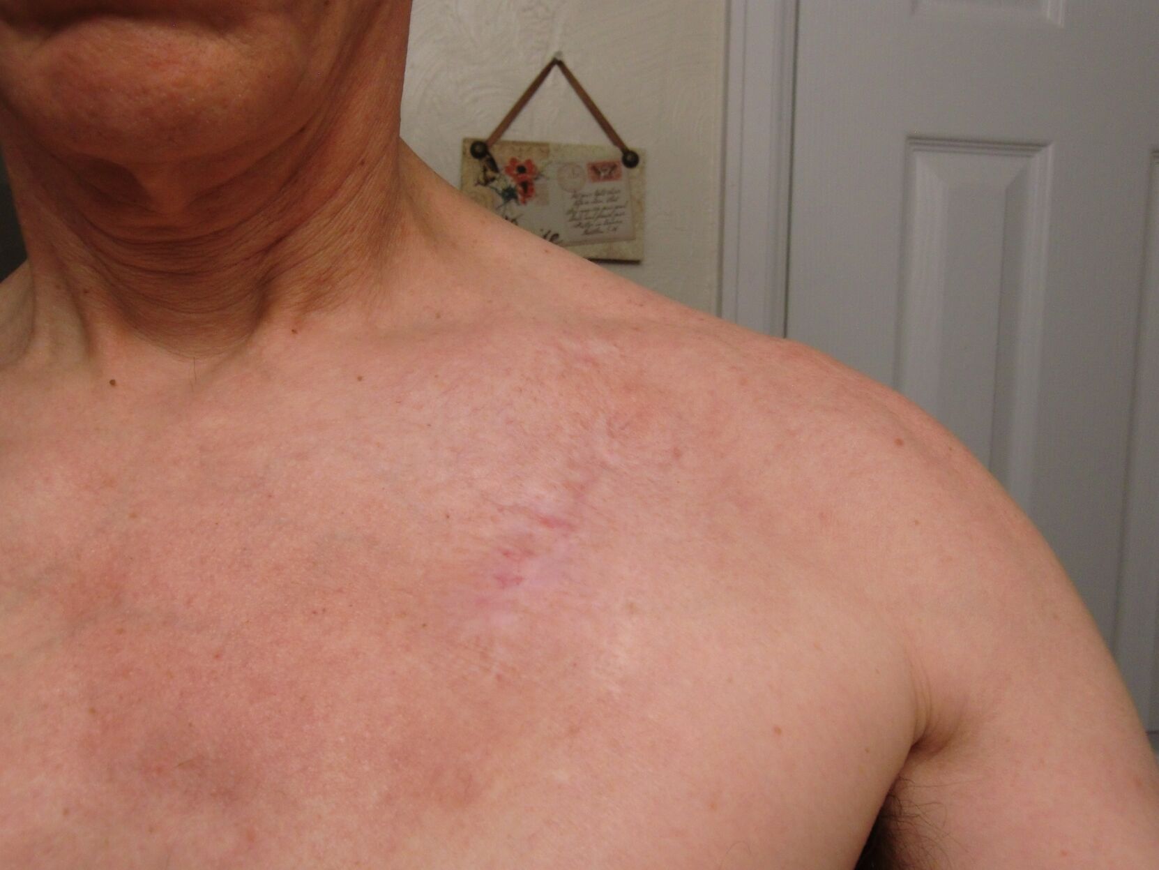 Mike Hoesch has ascar left on his chest after he believes God healed the malignant tumor he had for eight years. (Courtesy photo)