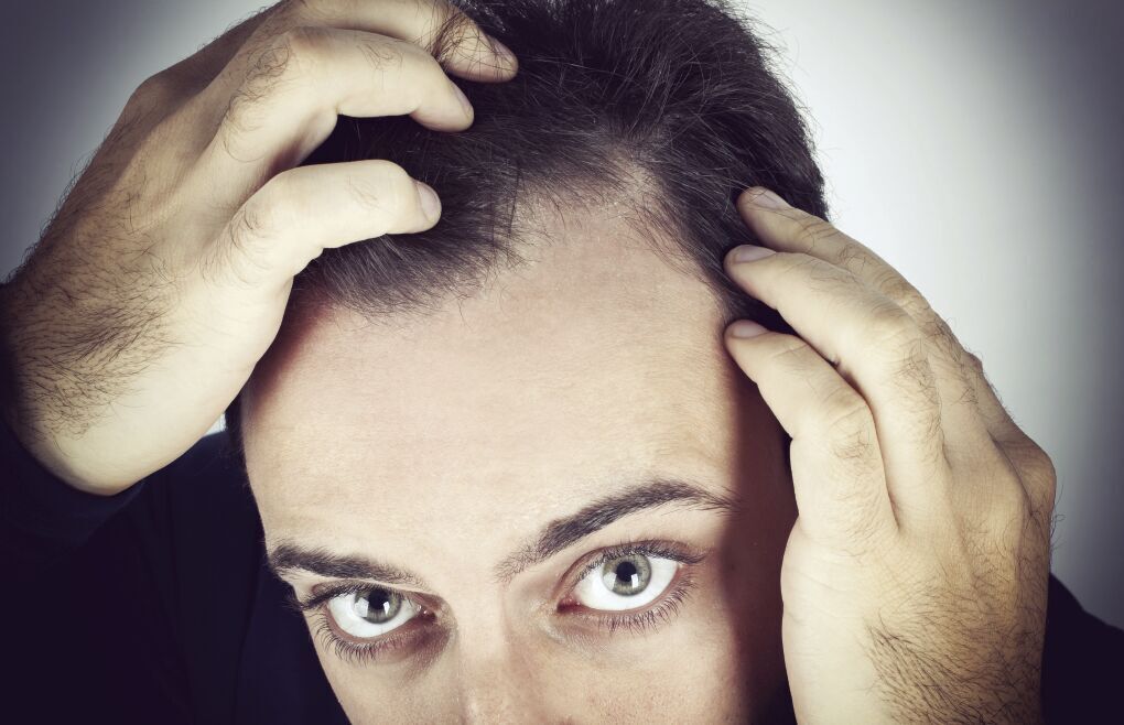 Live Well: Hair loss? You’re not alone