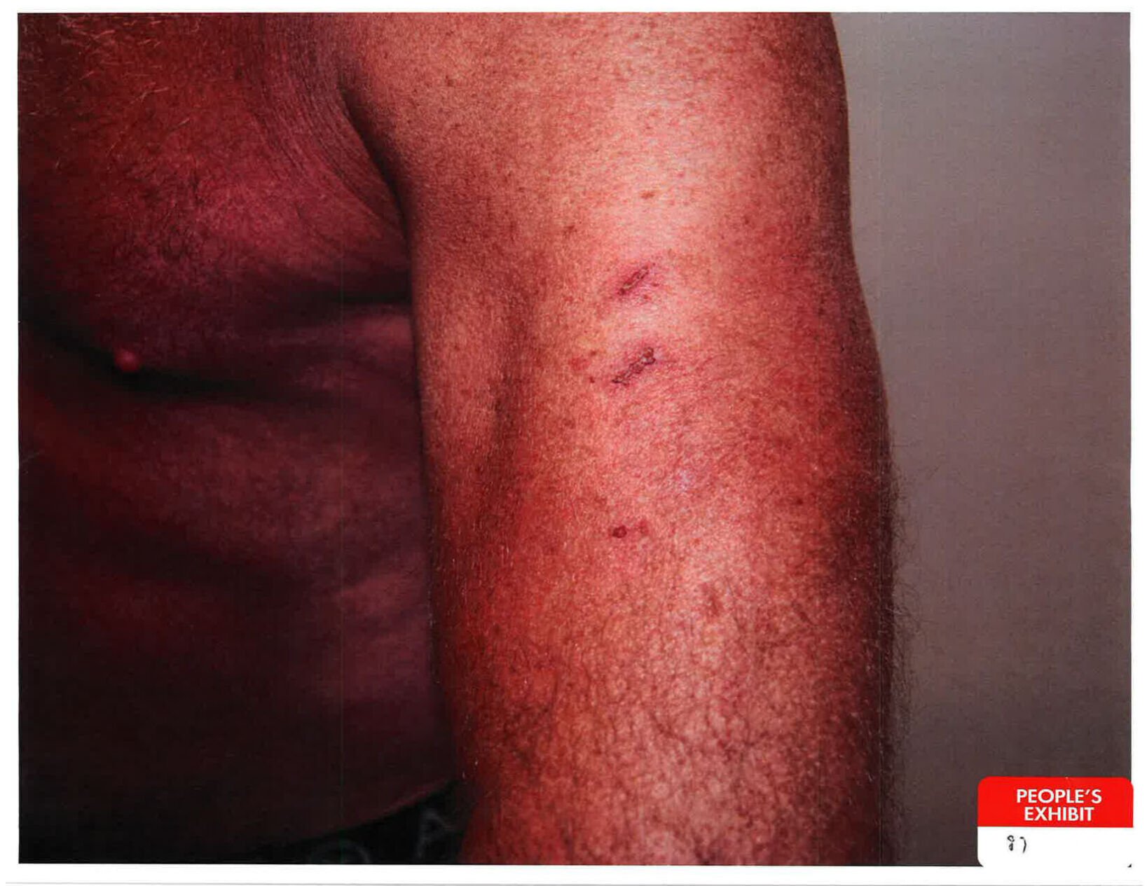 Chaffee County courts released to the public photo evidence that has been presented during the preliminary hearing of Colorado man Barry Morphew, who stands trial for the murder of his wife Suzanne Morphew. Pictured: A wound on Barry Morphew’s arm. (Courtesy: Chaffee County)