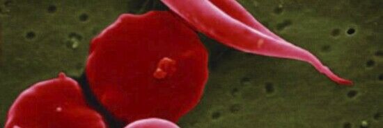 FDA approves world’s first CRISPR gene-editing drug for sickle-cell disease
