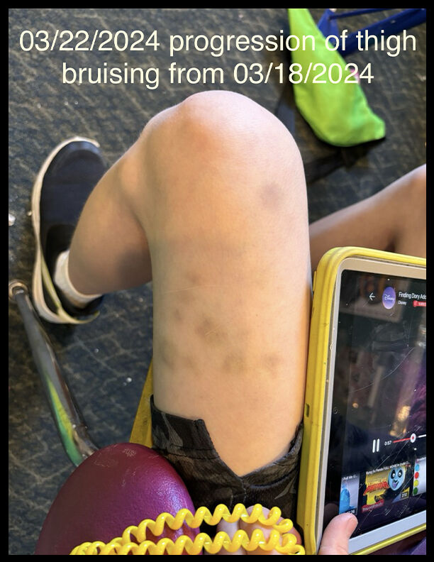 Injuries on a special needs child who rode on a Littleton Public Schools bus. (Courtesy, Rathod | Mohamedbhai LLC)
