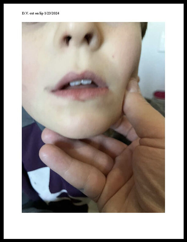 Injuries on a special needs child who rode on a Littleton Public Schools bus. (Courtesy, Rathod | Mohamedbhai LLC)