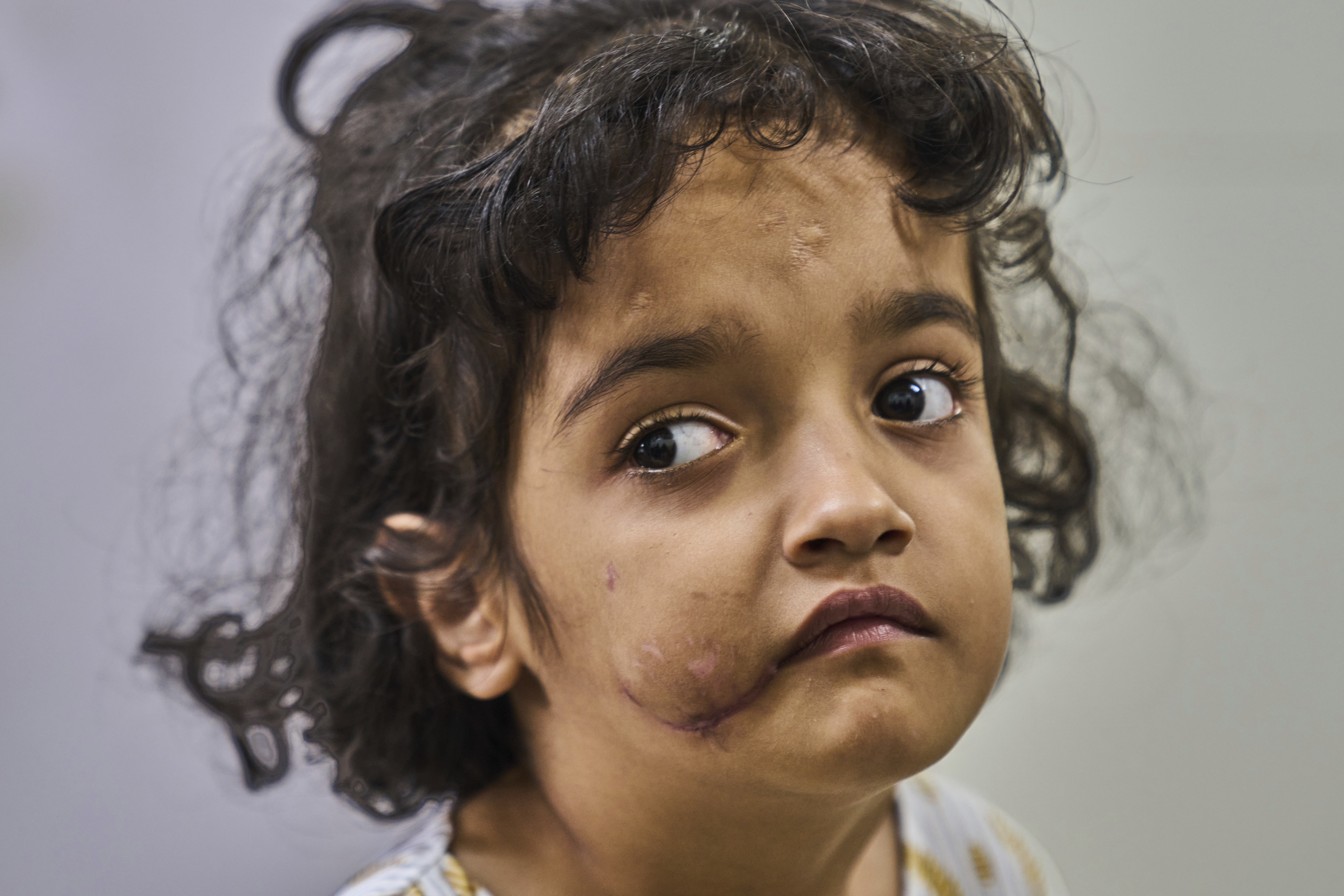 Rehmat Ashraf, 6, who was attacked by a stray dog outside her house, poses for a picture inside the anti-rabies clinic at a hospital in Srinagar, Indian controlled Kashmir, Thursday, Sept. 18, 2025. (Dar Yasin - AP)