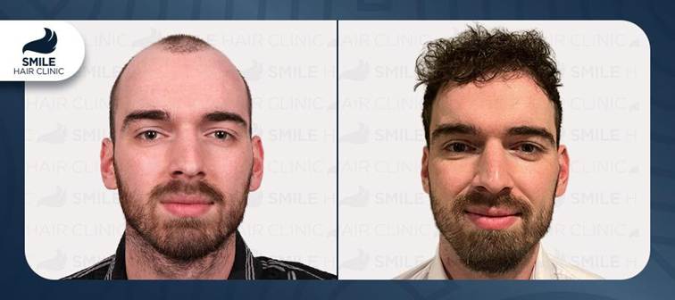 Hair transplant patient before and after photos