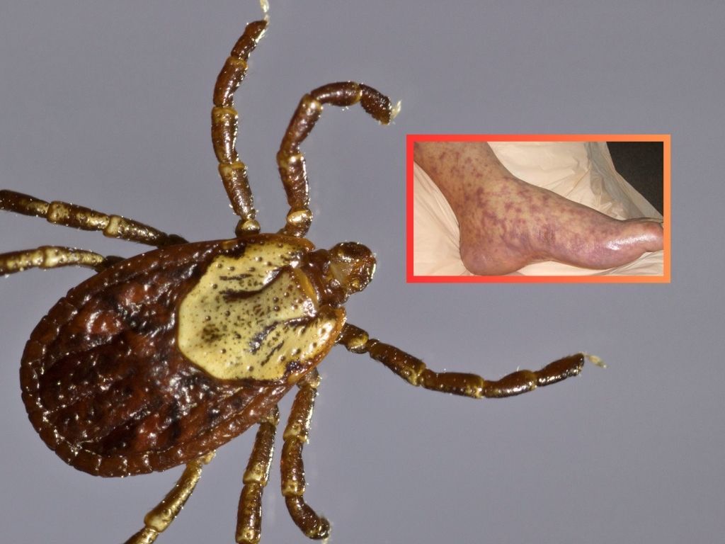 Deadly tick-borne illness is present in Colorado and can result in amputation or worse